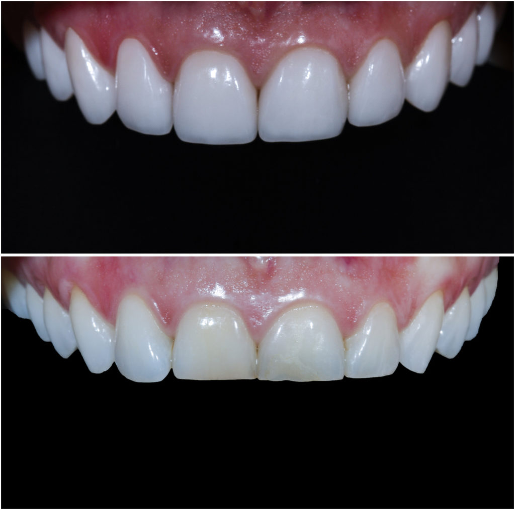 What is dental veneers before and after