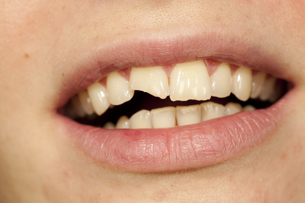 Large Broken Tooth