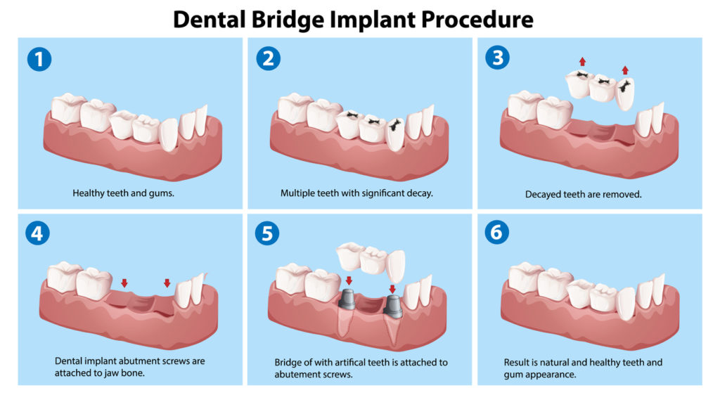 Implant Bridge Process