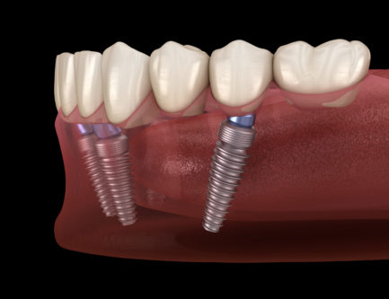 3-6 dental implants