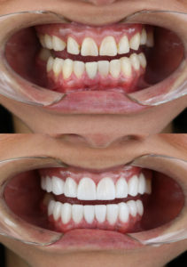Dental Veneer Before and After