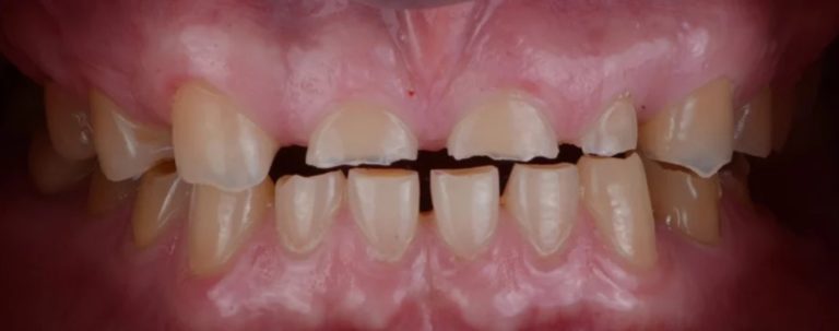 Bruxism and teeth attrition