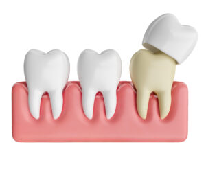 Emergency repair of dental crown at