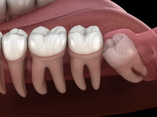 Wisdom Tooth Extraction Pulse Dental